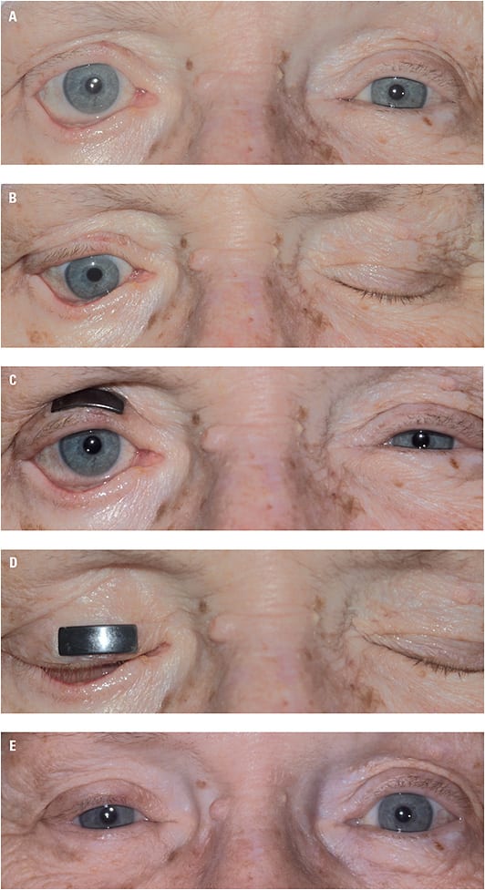 A: NK due to complete peripheral 7th nerve palsy, following resection of an acoustic schwannoma with paralytic lower lid ectropion; B: Same patient showing absence of Bell’s response and complete exposure of cornea with attempted closure; C: Test weight applied to upper lid demonstrating minimal baseline ptosis; D: Test weight eliminating lagophthalmos with closure (patient requires lower lid retraction repair as well); and E: Repair of upper lid retraction with gold weight, repair of lower lid paralytic retraction/ectropion with tarsal strip, porcine dermal collagen implant, and permanent lateral tarsorrhaphy.