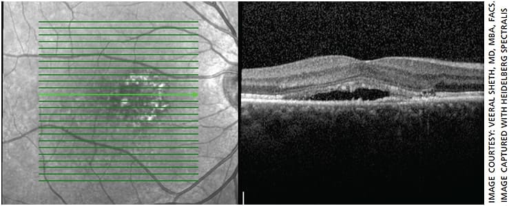 Figure 1. Angiogram of a patient with CSCR on day of treatment with micropulse laser.