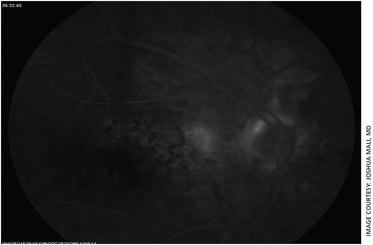 Figure 3. Late-phase FA OD showing late leakage consistent with a CNV lesion just temporal to optic disc. Due to the high index of suspicion with a positive ForeseeHome alert, meticulous additional testing with FA was ordered and proved to be critical to diagnose the early CNV lesion. Image taken with Topcon TRC-50EX.