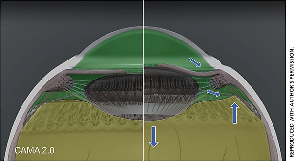 Figure 5. CAMA 2.0 demonstrating hydrodynamics of aqueous and vitreous in accommodation (right half) and disaccommodation (left half).