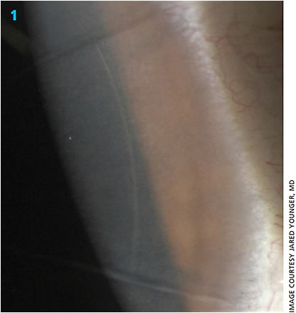 Figure 1. Manually adjusting the placement of AK incisions based on OCT imaging allows the surgeon to position AK incisions between old radial scars.