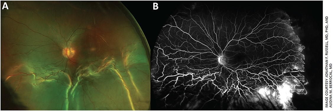 Figure 2. Ultra-widefield photograph (A) and fluorescein angiogram (B) of teenage male with Coats disease and exudative retinal detachment. Images obtained via Optos California.