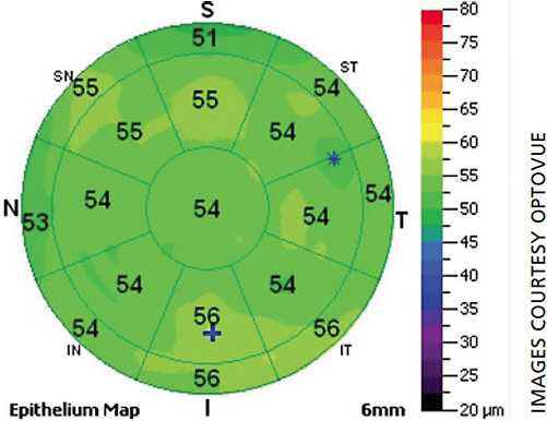 Figure 2. Epi map for a normal eye.