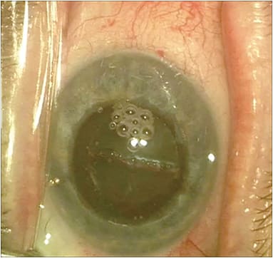 Figure 1. Preexisitng bleb from ExPress (Alcon) shown post femtosecond procedure.