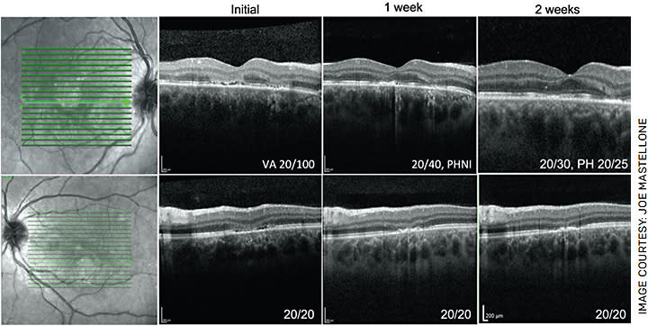 FIGURE 4. OCT of the macula at 1- and 2-weeks following initiation of prednisone treatment showing reconstitution of the outer nuclear layer and improvement in the hyperreflectivity of the outer retina OU. Visual acuity OD improved from 20/100 to pinhole 20/25.