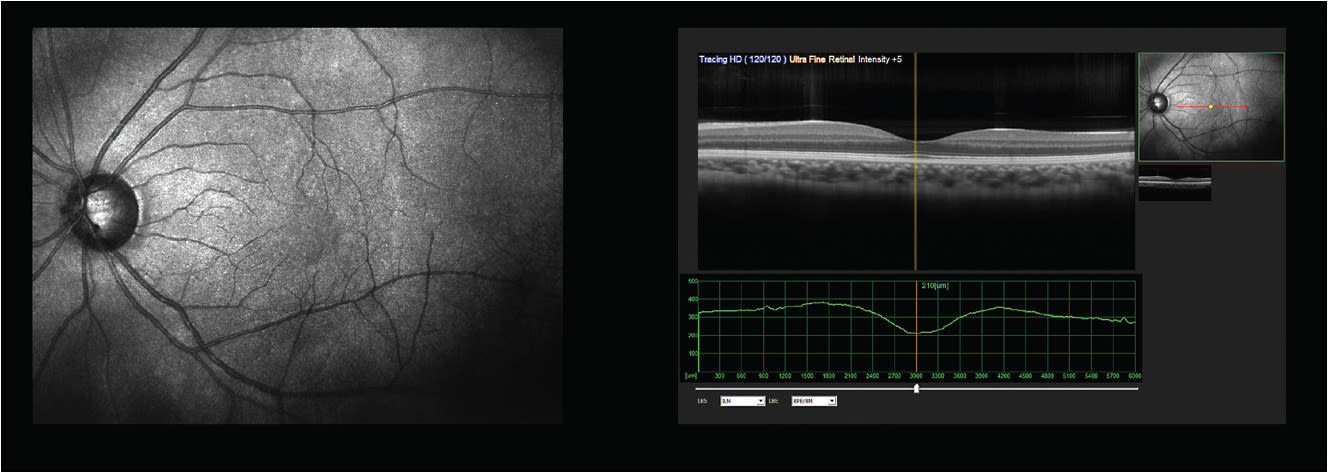 FIGURE 1. Example of OCT cross section and associated infrared image of a healthy eye.