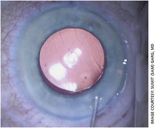 Figure 1. Intraoperative view of the Eyhance toric IOL (Johnson &amp; Johnson Vision). Note that the Eyhance is indistinguishable on exam from a Tecnis ZCB00 monofocal/toric.