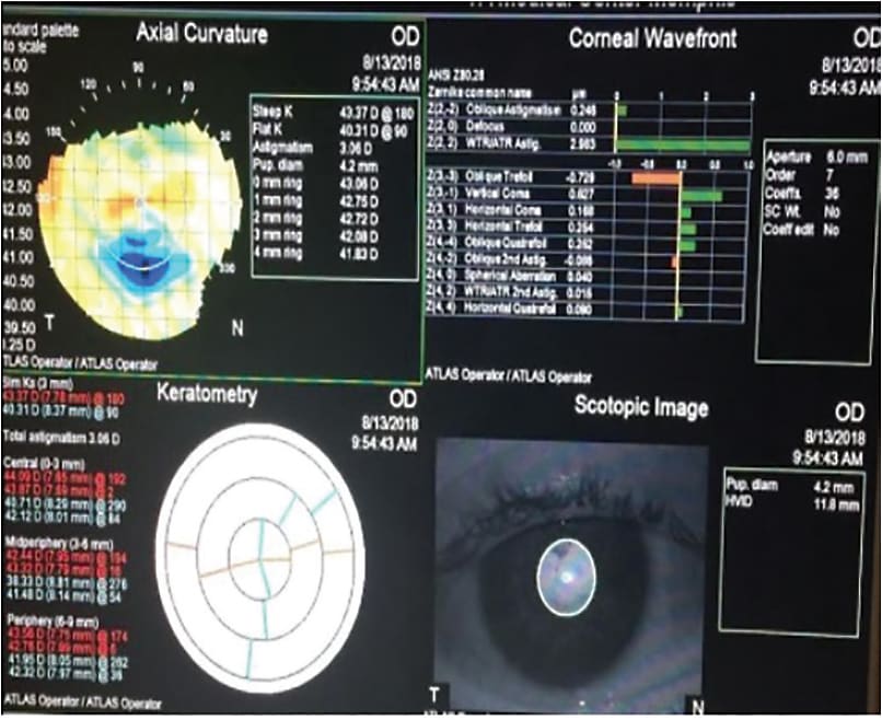 Figure 1. Atlas photos of cornea OD taken at preoperative visit.