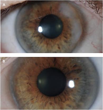 CASE 3. Note this patient’s “growing white spot” (A), and her clear and pristine eye post amniotic membrane graft (B).