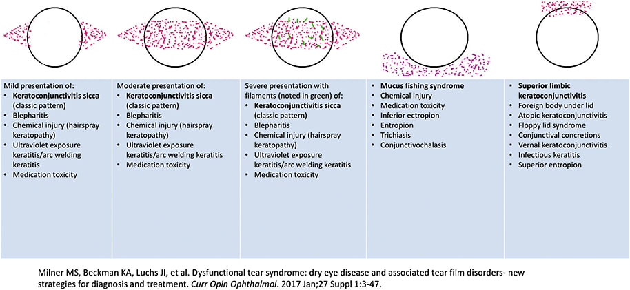 Figure 2. Ocular surface lissamine green/rose Bengal staining patterns