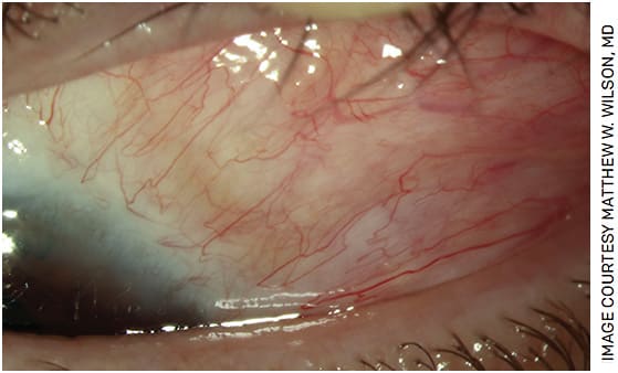 FIGURE 4. No clinical signs of residual conjunctival melanoma near the limbus, where the amniotic membrane graft is in place.