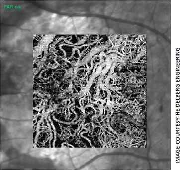 Geographic atrophy image from the Spectralis.