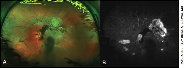 Figure 2. Proliferative diabetic retinopathy with subhyaloid hemorrhage and vitreous hemorrhage: Color photograph (A) shows severe neovascularization at the disc and elsewhere along with vitreous hemorrhage and subhyaloid hemorrhage. There is blockage from the hemorrhage on the UWFFA (B) and leakage from neovascularization at the disc and elsewhere, along with extensive peripheral nonperfusion.