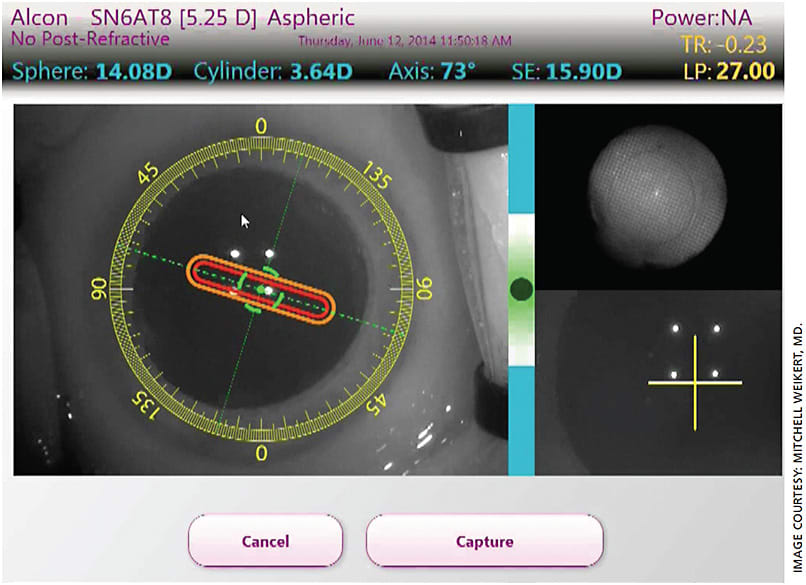 Figure 1. Aphakic image acquisition with IA (ORA, Alcon) showing aphakic sphere, cylinder and axis measurements intraoperatively.