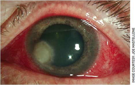 FIGURE. Slit lamp photo demonstrating a well-demarcated epithelial defect with a dense underlying infiltrate with feathery edges.