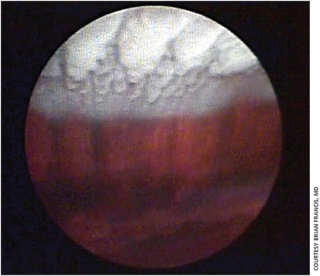 Figure 1. Endoscopic surgical image of ECP Plus procedure. The treated ciliary process and confluent row of the treated pars plana are visible.