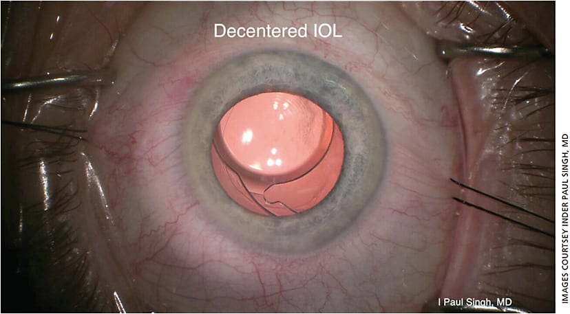 A photo taken just prior to an IOL exchange, displaying a one-piece multifocal lens that has decentered nasally. The IOL was originally properly centered but shifted postoperatively.