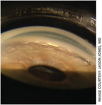 Figure 4. Postoperative view of the Hydrus Microstent (Ivantis) in situ within Schlemm’s canal.