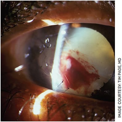 FIGURE 2. When presented with a penetrating injury, a B-scan ultrasound may be used to view the posterior capsule to assess for capsular rupture. Preoperative planning and testing can save time and stress in the operating room.