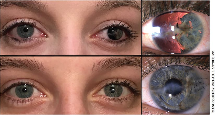 Figure 1. Custom, flexible iris prosthesis slit lamp (right) and mid-face (left) images, preop (top) and postop (bottom).