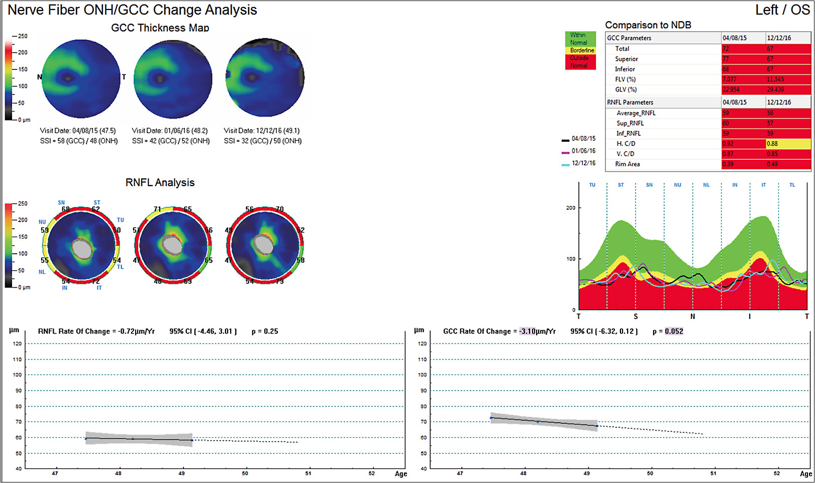 Figure 3. Case 2: OCT demonstrates the absence of a floor effect for GCC measurements as opposed to the floor effect observed for RNFL measurements.