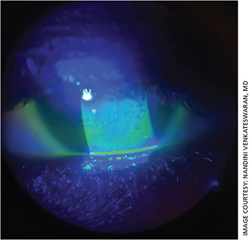 Figure 1. Slit lamp photograph showing dense confluent punctate keratopathy in a patient who developed ocular and systemic graft versus host disease after a bone marrow transplant for sickle cell disease.