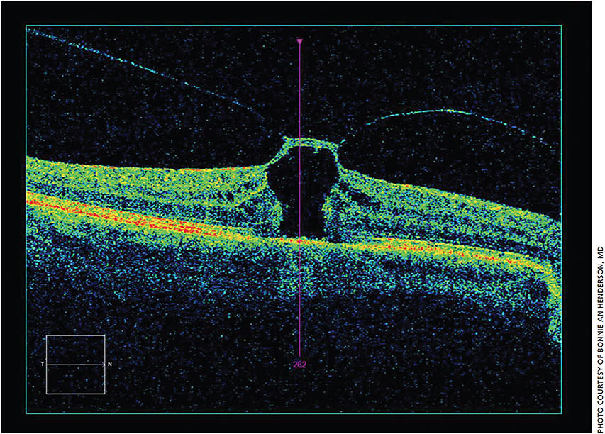 OCT of vitreomacular traction with macular edema found prior to cataract surgery.