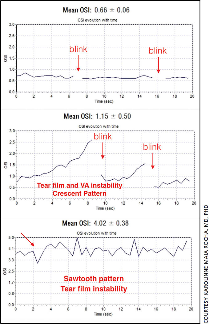 Figure 2. Comparison of double-pass wavefront tear film analysis in three subjects. The first (top) has a normal mean OSI of 0.66 and a steadily low OSI that remains stable between blinks. In a patient with dry eye (middle), the mean OSI is higher (1.15) and the OSI steadily increases, but recovers immediately post-blink. In severe dry eye (bottom), the OSI may be very high (4.02 in this example), and the pattern over time is erratic but consistently high.