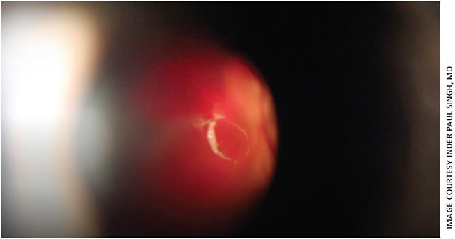 Figure 3. A view of an amorphous cloud-type floater through a YAG vitreolysis laser.