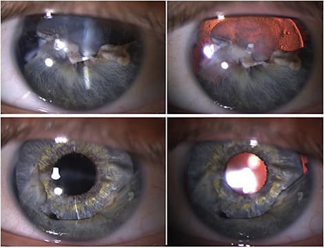 This patient had cataract surgery and in-the-bag custom iris placement for reduced vision and glare following excision of an iris melanoma. Her symptoms fully abated, and she recovered 20/25/J1 uncorrected vision. As the iris device was fully within the capsular bag, the excision site can still be well viewed by gonioscopy. The high mag and mid-face photos demonstrate the nice restoration of a normal appearance as a happy by-product as well.