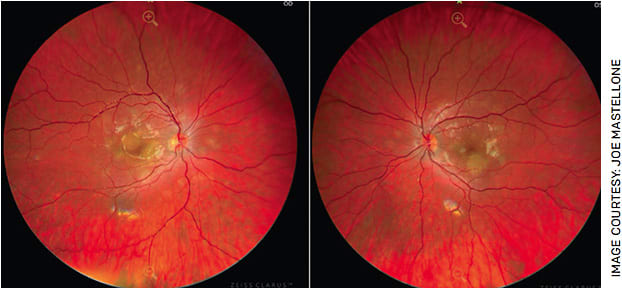 FIGURE 1. Color fundus photos OU demonstrating multiple flat, creamy yellow lesions involving the macula in the right eye (left image) and a single large flat, creamy yellow lesion with several surrounding smaller lesions sparing the fovea in the left eye (right image).