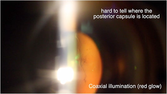 Figure 6. A rope-like floater behind the lens. Due to full red glow of the coaxial beam (slit lamp in the center position), it is hard to tell where the posterior capsule is located. Not recommended to fire until the surgeon identifies the posterior capsule.