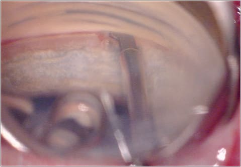 Intraoperative photo of the Kahook Dual Blade. Note the bunching of the trabecular meshwork to the left of the device. To the right of the device, the trabecular meshwork has already been removed, and the back wall of Schlemm’s canal is visible.