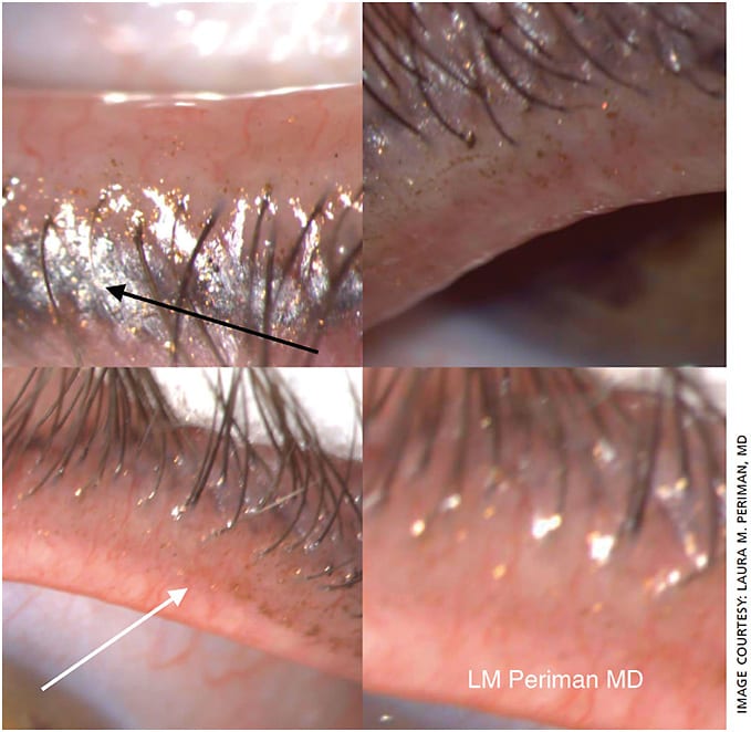 Figure 2. A 58-year-old patient with clinically significant dry eye sign and symptoms reported complete removal of eye makeup the night before. Note the debris left behind.