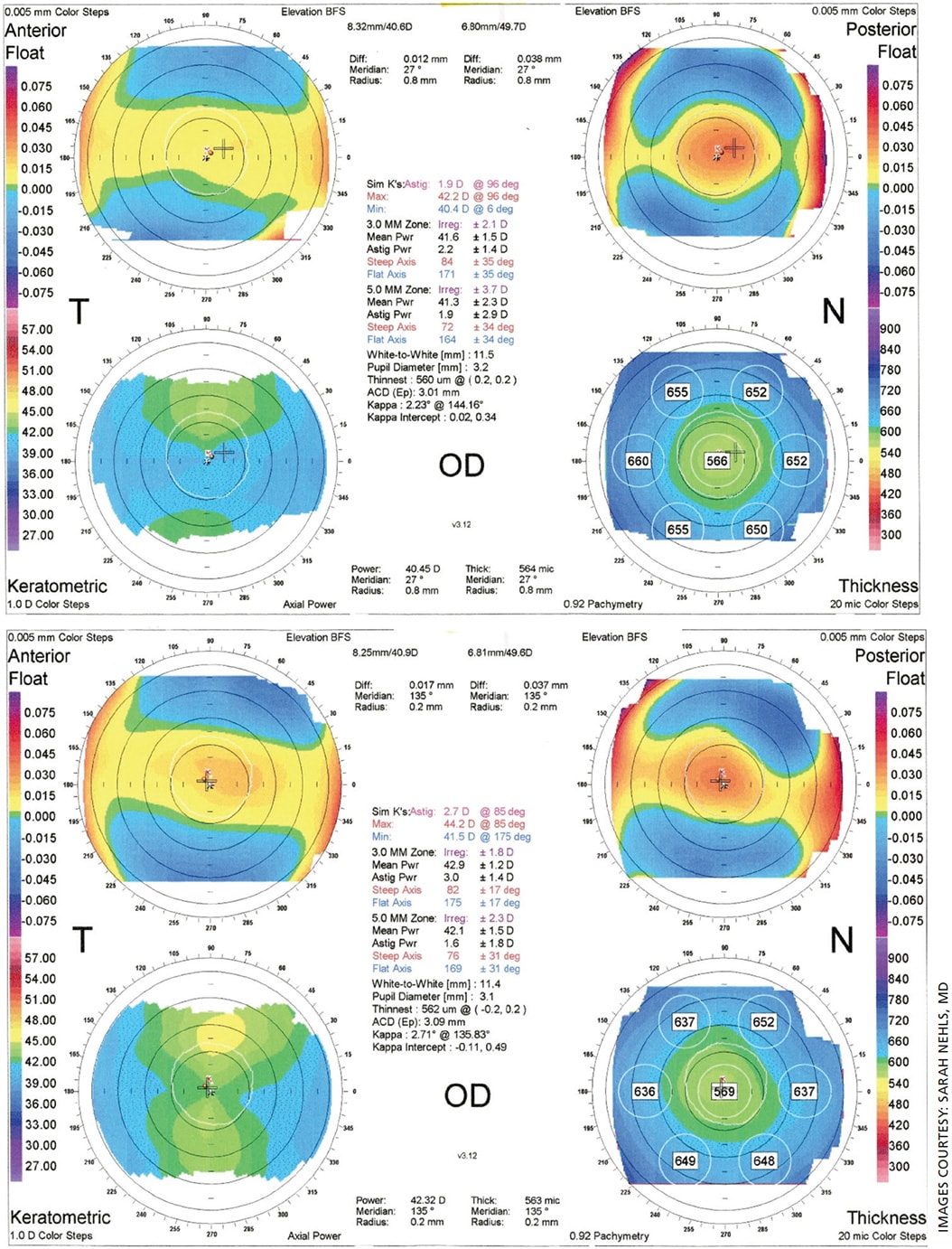 Figure 1 (top). Corneal warpage caused by years of RGP wear. Captured on the IOL Master 700 (Carl Zeiss Meditec). Figure 2 (bottom). Regular with-the-rule corneal astigmatism 4 months after stopping RGP wear.