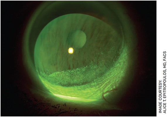 FIGURE 3. MGD with punctate epitheliopathy and reduced TBUT.