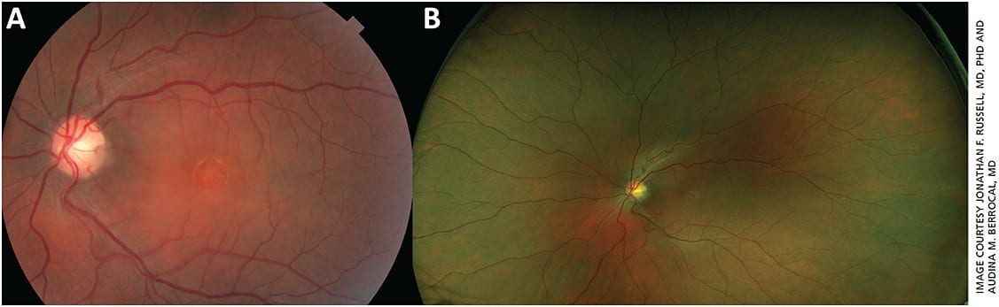 Figure 1. Comparison between traditional fundus photography (A) and ultra-widefield fundus photography (B) in a patient with optic pit and serous macular detachment. Note in B that much of the retinal surface can be seen, but it is harder to discern fine details in the macula. Images obtained via Topcon and Optos devices.