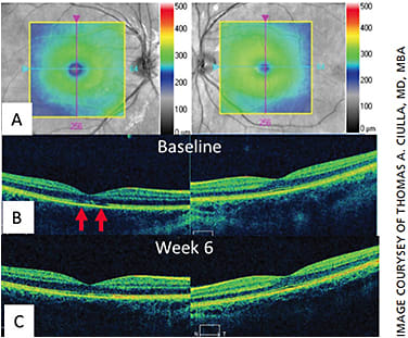 Figure 4. Subtle ellipsoid zone disruption with subsequent improvement after laser pointer injury.