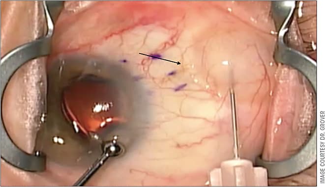 Figure 5. Intraoperative photograph demonstrating the technique used to inject MMC after the Xen 45 has already been implanted. The black arrow denotes the tip of the Xen 45 implant in the subconjunctival space. The anterior chamber is pressurized with viscoelastic to prevent reflux of MMC into the anterior chamber.