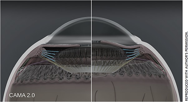 Figure 1. CAMA 2.0 demonstrating anterior zonules in accommodation (right half) and disaccommodation (left half).