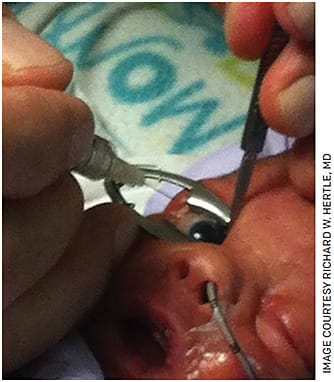 Figure 1. Neonatal intraocular injection of anti-VEGF for retinopathy of prematurity.