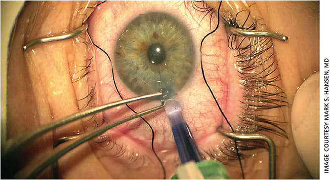 Figure 1. Injection of the graft into the anterior chamber.