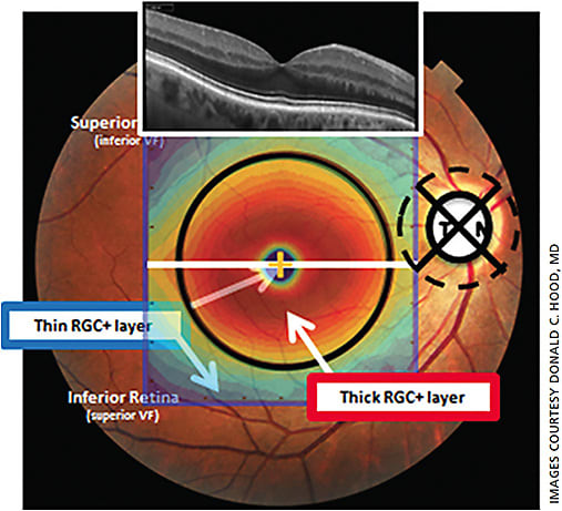 Figure 1. A pseudo-color map of the average retinal ganglion cell plus inner plexiform (RGC+) thickness of a group of healthy eyes superimposed on a fundus photograph. The macular region, ±8° from fixation, falls within the black circle. The white line indicates the location of the OCT b-scan above.