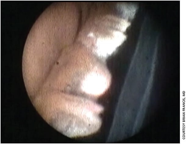 Figure 2. Endoscopic surgical image of endoscopic cycloplasty (ECPL) procedure for severe plateau iris syndrome. The ciliary processes are large and anteriorly rotated against the posterior iris. The processes in the top part of the image have been treated and are shrunken and whitened, while the processes in the bottom part are still large with significant iris contact.