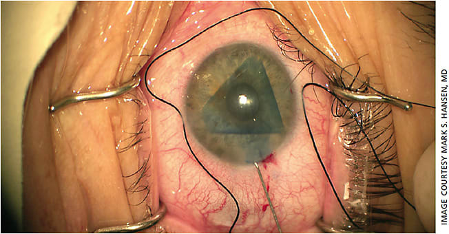 Figure 2. The trifold graft being unfolded within the eye.