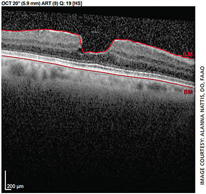 Figure 1. An image showing irregular OCT of the macula with epiretinal membrane.