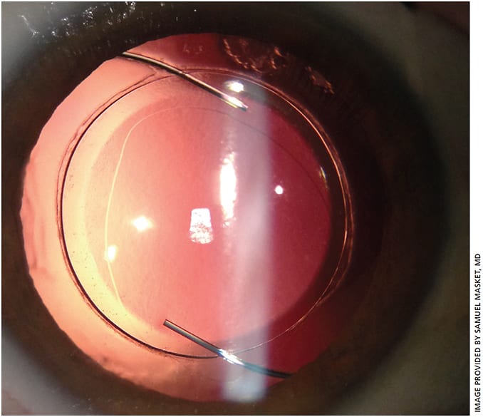 Figure 1b.  Anterior capsule laceration (postoperative).