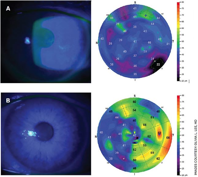 Figure 1A. Slit lamp photos and epithelial thickness maps in Stage 1 NK secondary to prior herpes simplex epithelial keratitis before (top left) and after (top right) Oxervate therapy.Figure 1B. Slit lamp photos and confocal microscopy in Stage 2 NK in trigeminal neuralgia before (bottom left) and after (bottom right) Oxervate treatment.