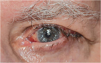 Figure 2: Lateral suture tarsorrhaphy narrowing the palpebral fissure in a monocular patient with a nonhealing corneal transplant.