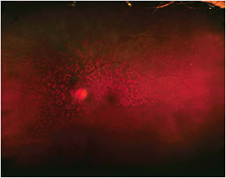 Figure 2. Left eye wide-field fundus photograph.